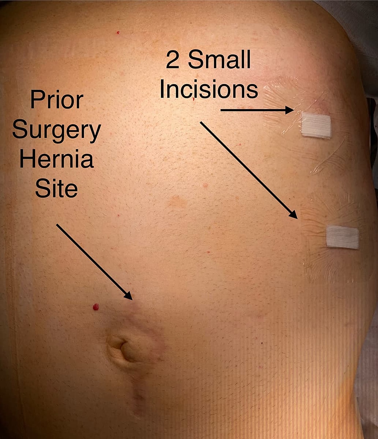 NYC Incisional Hernia Repair, prior hernia surgery site with small incisions marked.