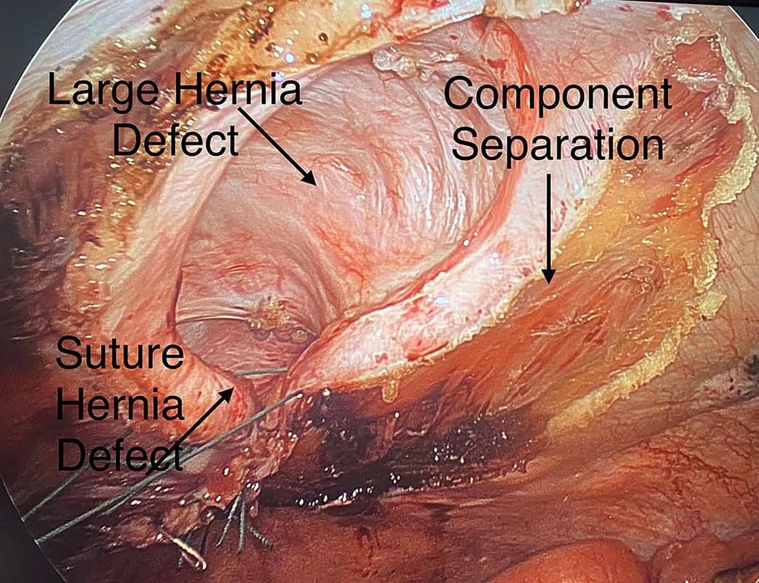 NYC Incisional Hernia Repair, intraoperative view of hernia defects and separation.
