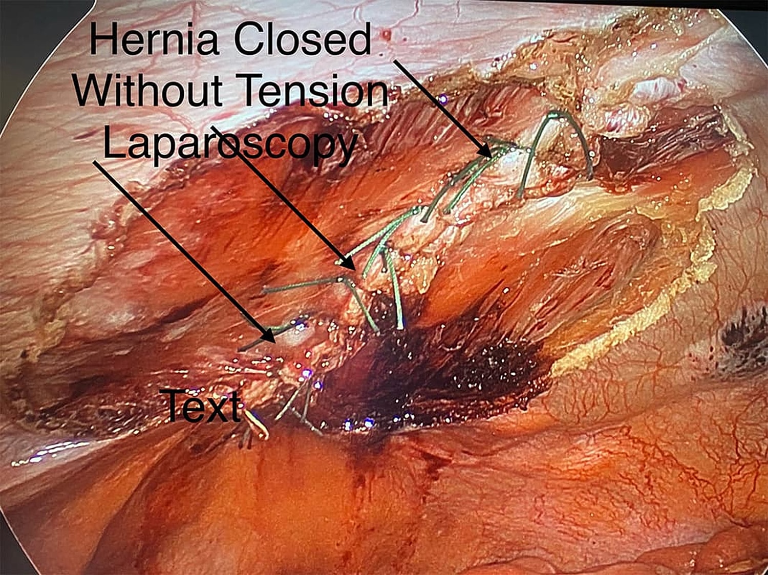 NYC Laparoscopic hernia repair without tension displayed.