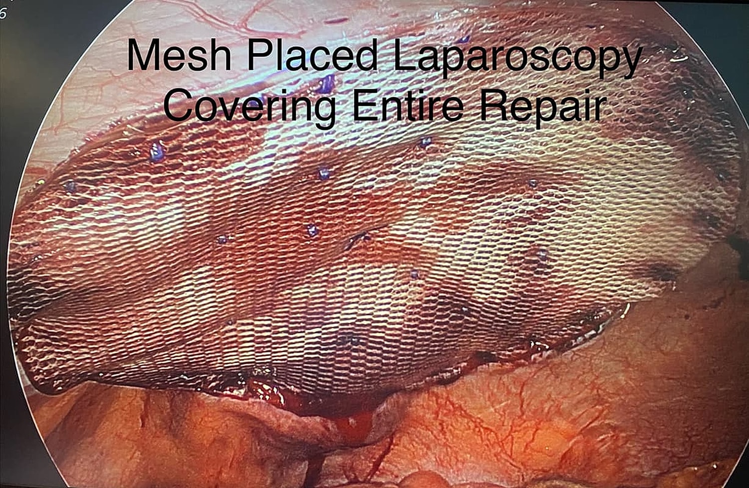 NYC Laparoscopic mesh repair procedure image.